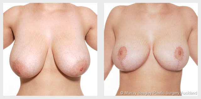 breast reduction Auckland - before after plastic surgery