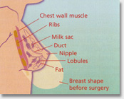 Breast Reduction cosmetic surgery Auckland