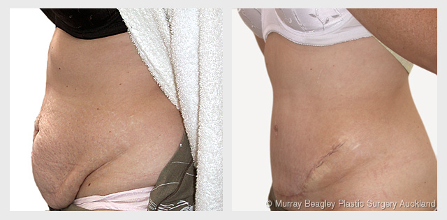 before after Abdominoplasty tummy tuck surgery