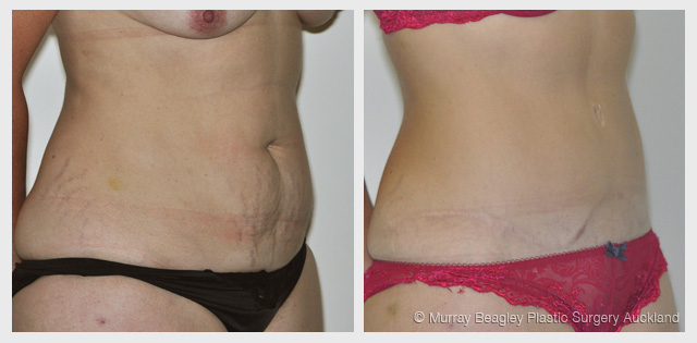 before after Abdominoplasty tummy tuck surgery