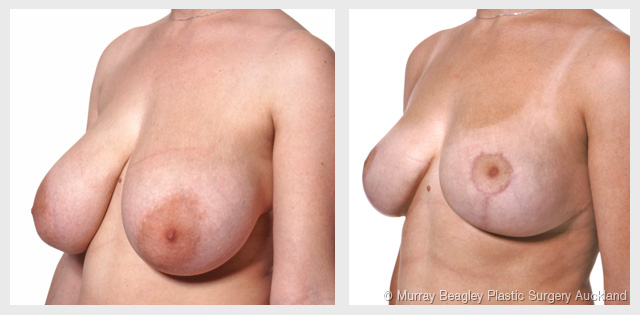 breast reduction before after surgery