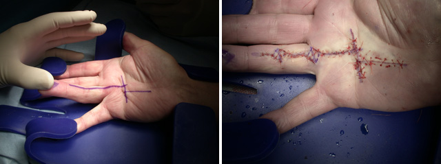 dupuytren's hand surgery Auckland NZ